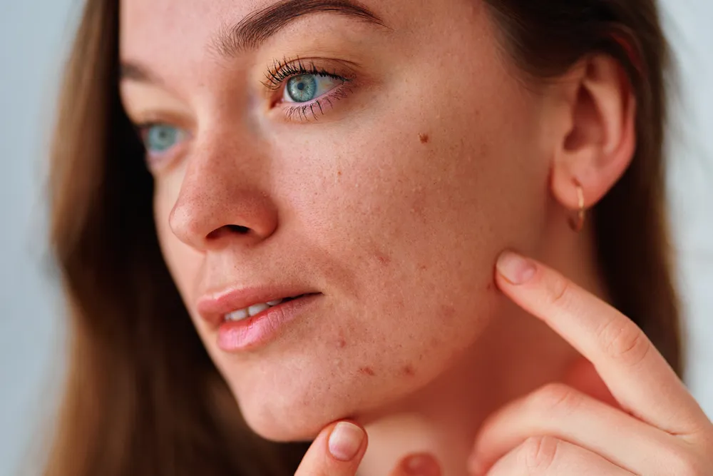 Close- up of dry,acne-prone skin texture 
